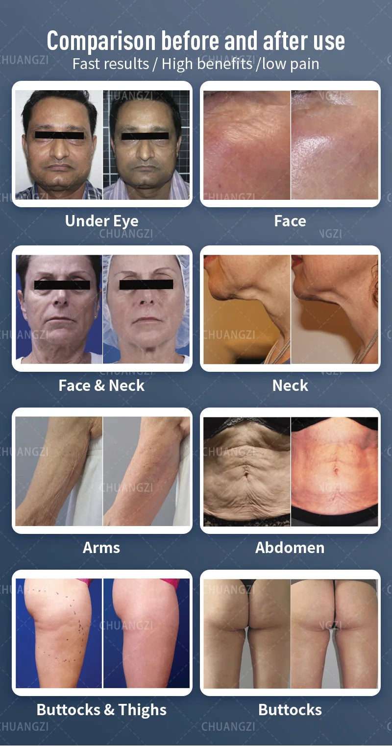 The latest equipment for skin tightening, vacuum slimming and fat removal, traditional skin lifting and spa equipment